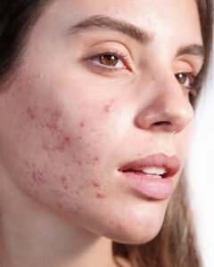 How to remove acne from face